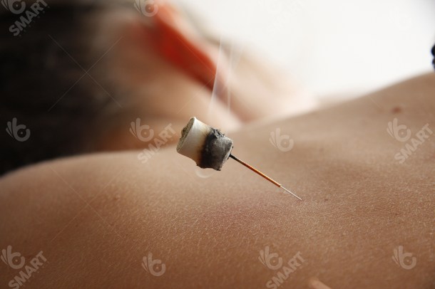 16 Acupuncture Moxibustion (3300x2200)-PH 1539